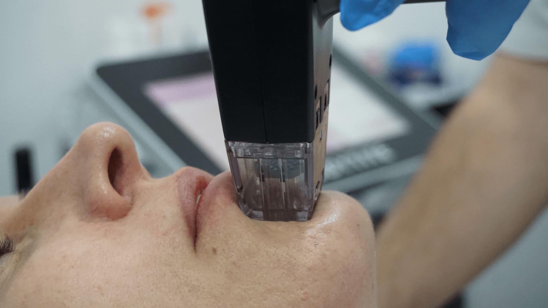 Lasers for Skin Tightening and Rejuvenation