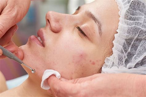 Acne Facials