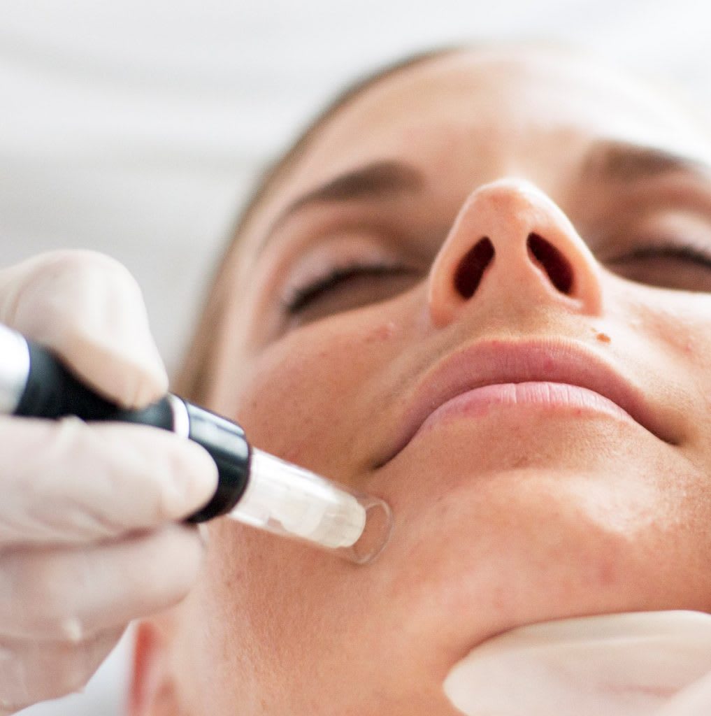 Microneedling